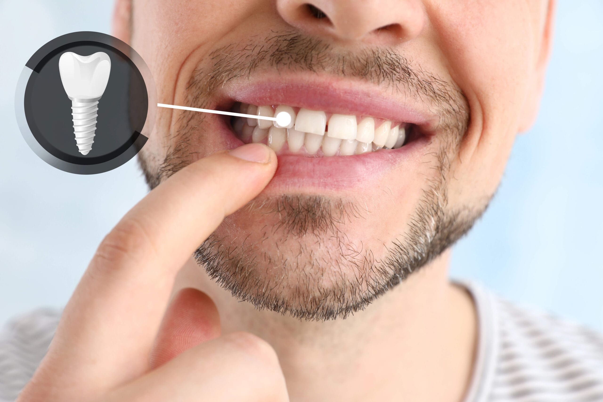 Permanent Tooth Replacement: Options and Benefits